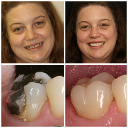 Before and after photo of crown placement