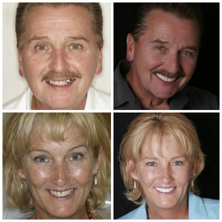 Photo of real patients who have received dental implants from Dr. John Nosti in New York