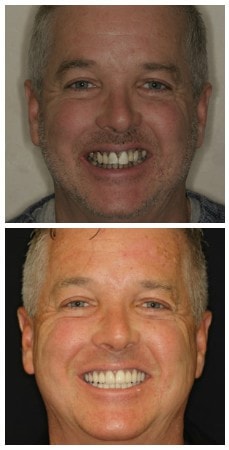 Photo of before and after full mouth rehabilitation