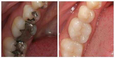 Photo of Inlays and Onlays performed by New York dentist Dr. John Nosti