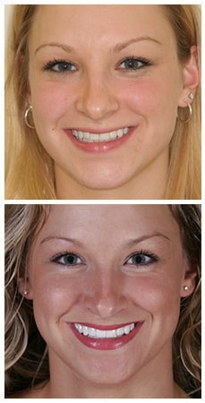 A photo of Jen a patient of Dr. Nosti who underwent smile design treatment