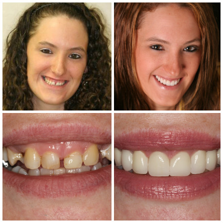 Photo of Mary a New York Dental Patient who received gum contouring