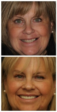 Photo of a real patient who underwent smile design treatment in New York 