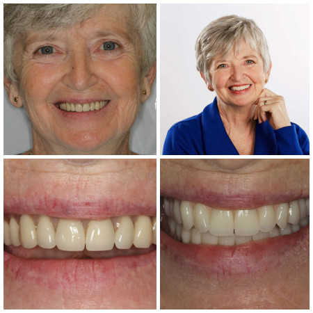 Photo collage of a real patient who received dentures from Dr. John Nosti