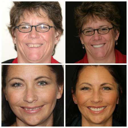 Photo of real patients with Porcelain Veneers from Dr. Nosti