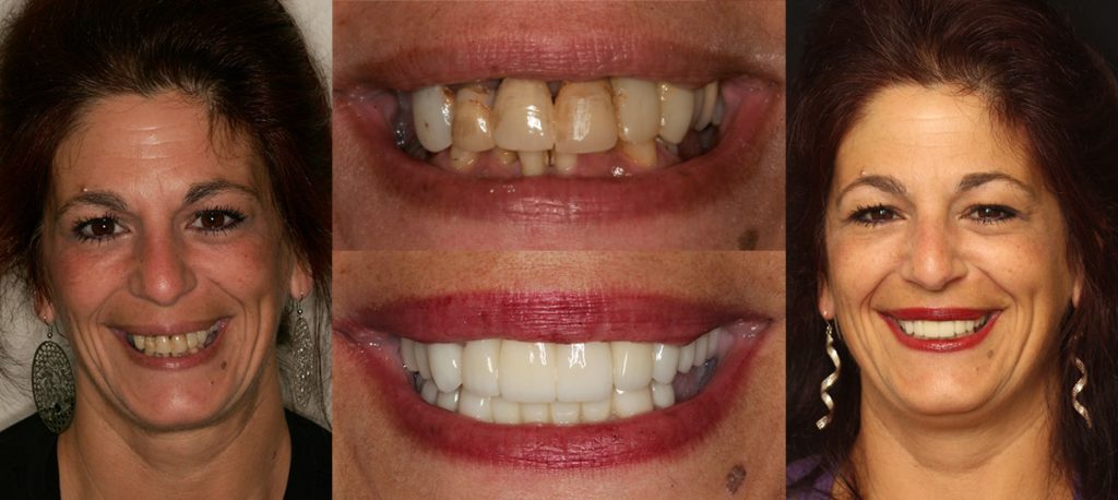 New Jersey Porcelain Veneers Smile Deficiencies Resolved By Dr Nosti