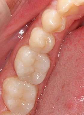 An up close view of dental work done by NYC smile design.