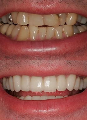 An up close view of dental work done by NYC smile design.