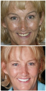 Before and after dental implant case