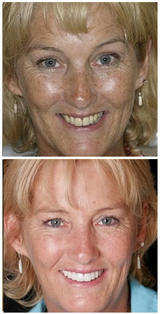 Photo of a real patient who underwent dental implants treatment in New York 