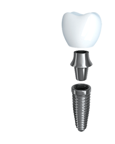 Anatomy of the three parts of a dental implant: post, abutment, and crown.